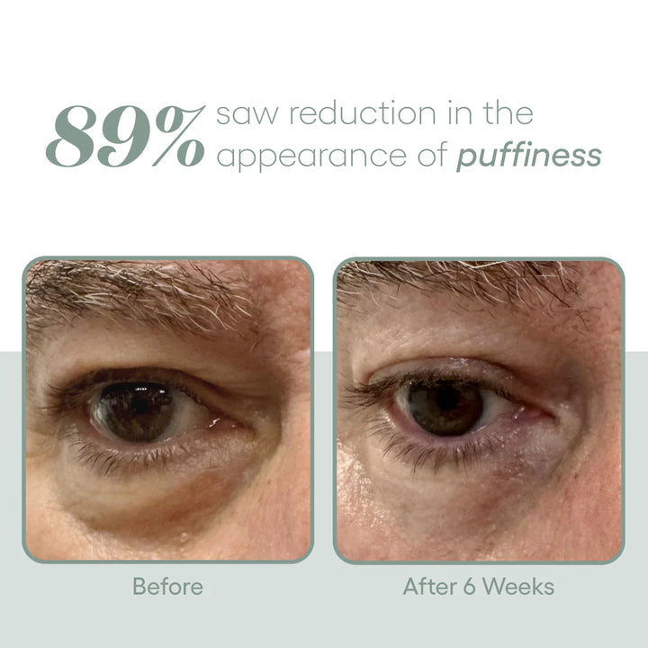 Exosome Eye Bags Cosmetic Treatment Before and After Photo